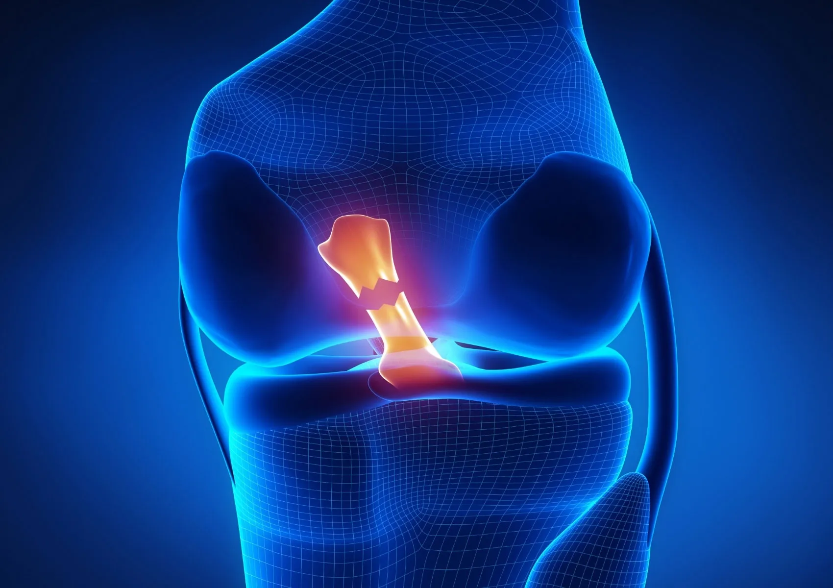 Posterior Cruciate Ligament (PCL) Tear: Rare but Serious