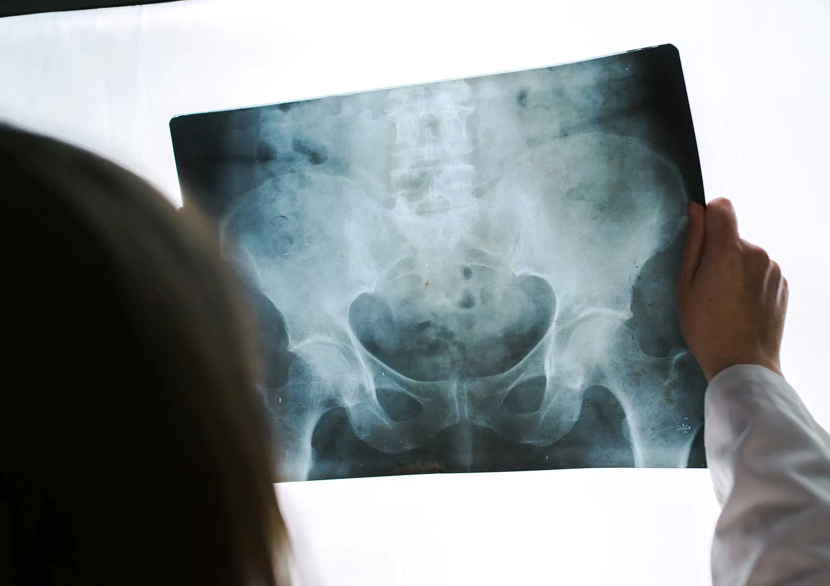 Treatment of Femoroacetabular Impingement with Arthroscopy