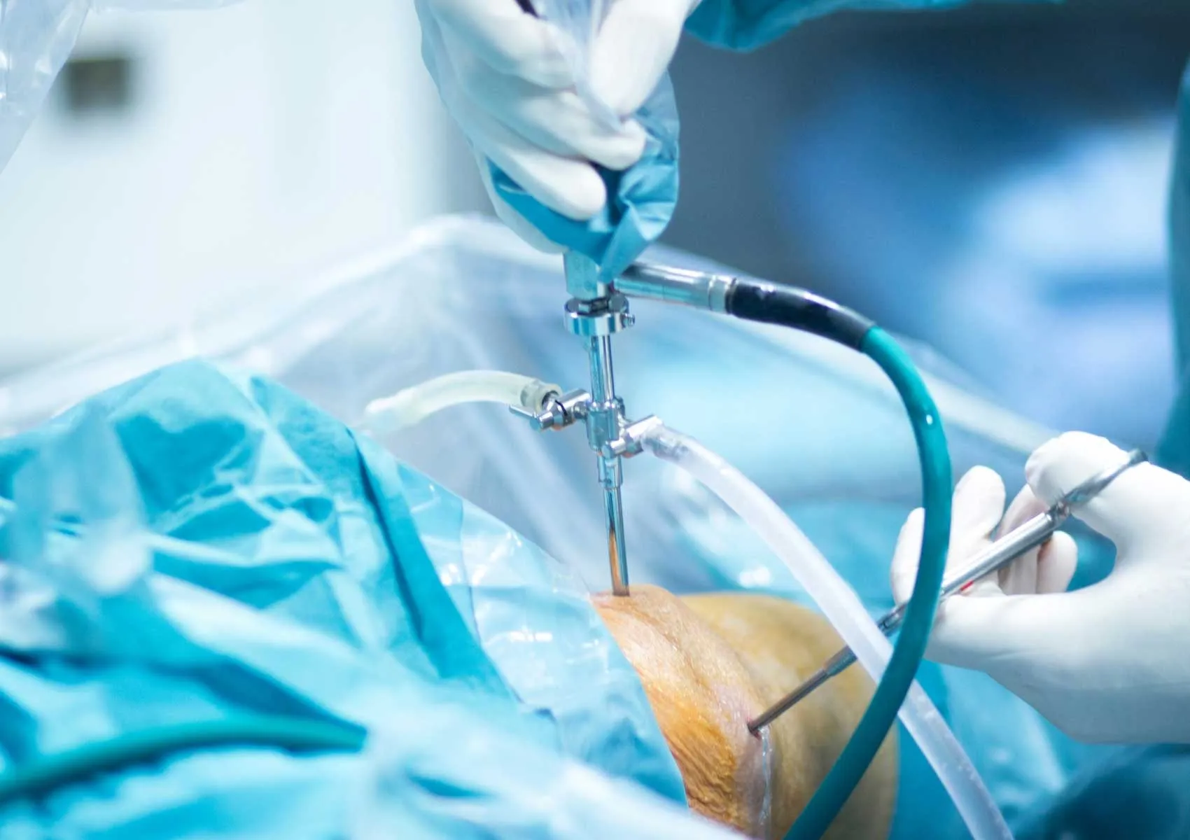 Artroskopik Yöntemle Bağ Onarımları