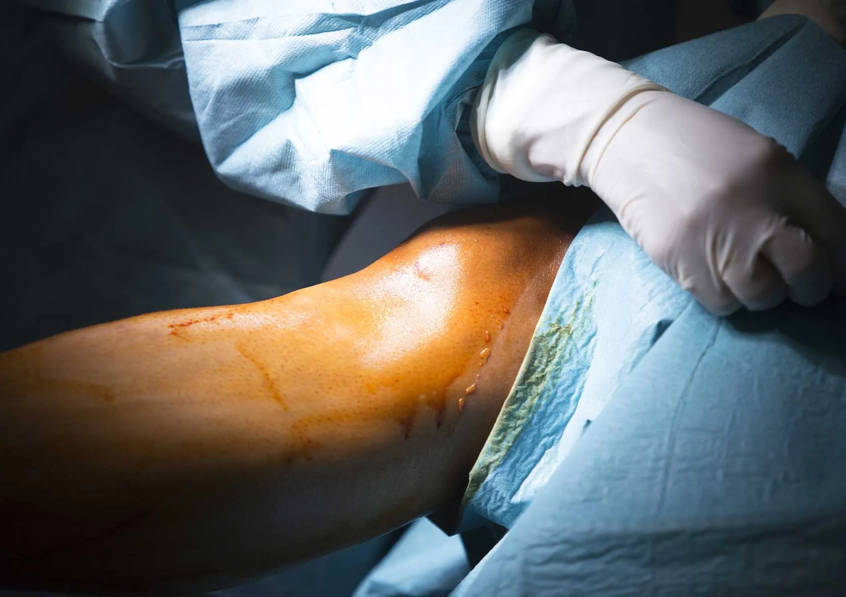 Diz Artroskopisi mi, Açık Cerrahi mi?