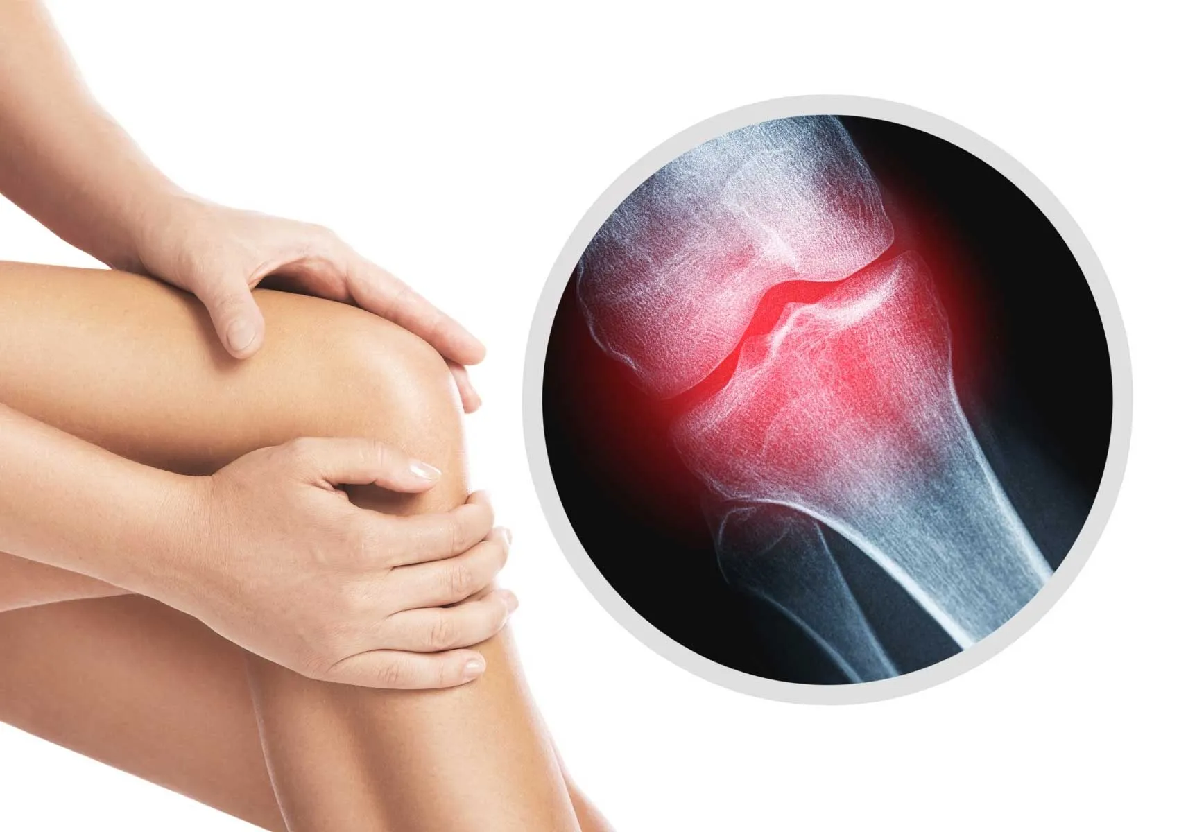 Cartilage Damage in the Knee: Why Early Intervention Matters