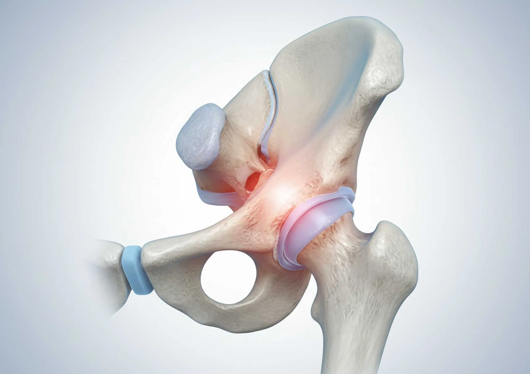 Femoroasetabuler Sıkışma (FAI): Belirtileri ve Nedenleri