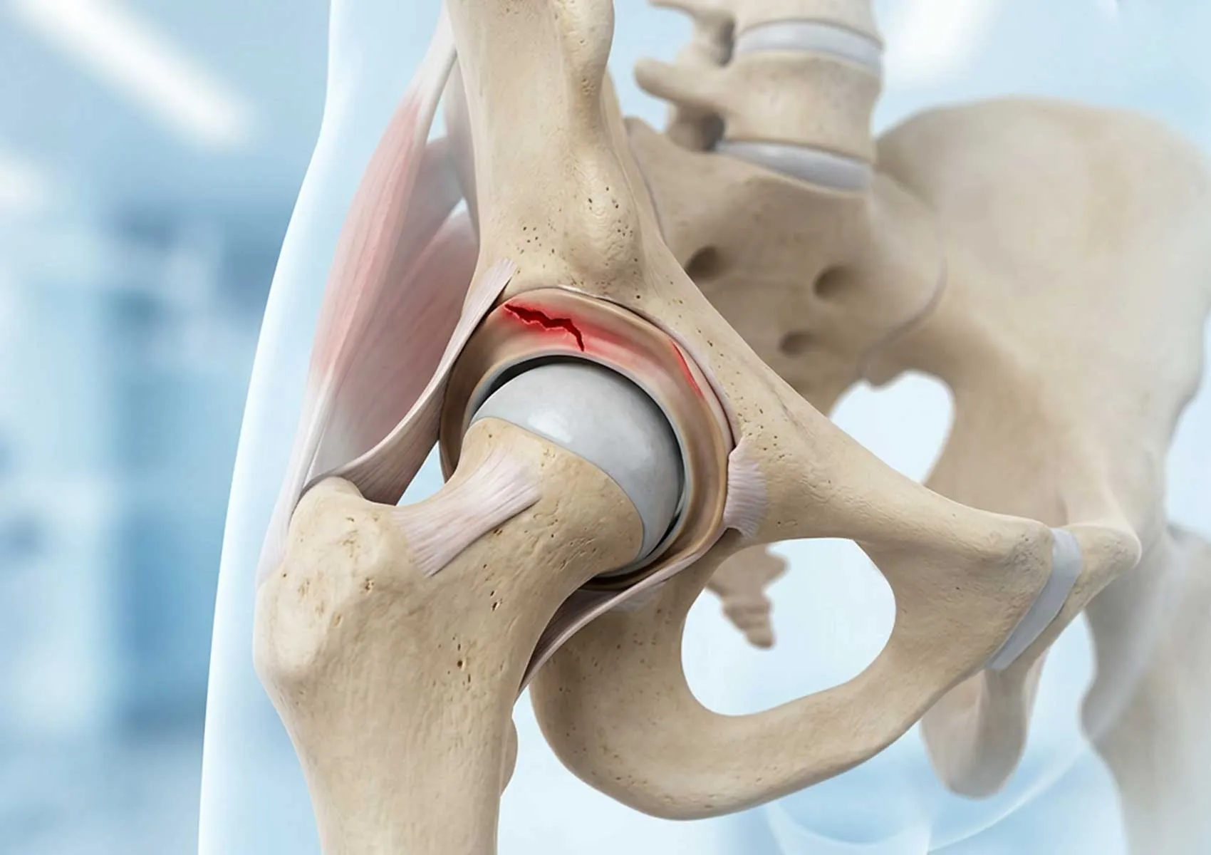 Kalça Labrum Yırtığı Belirtileri Nelerdir? Uzman Rehberi