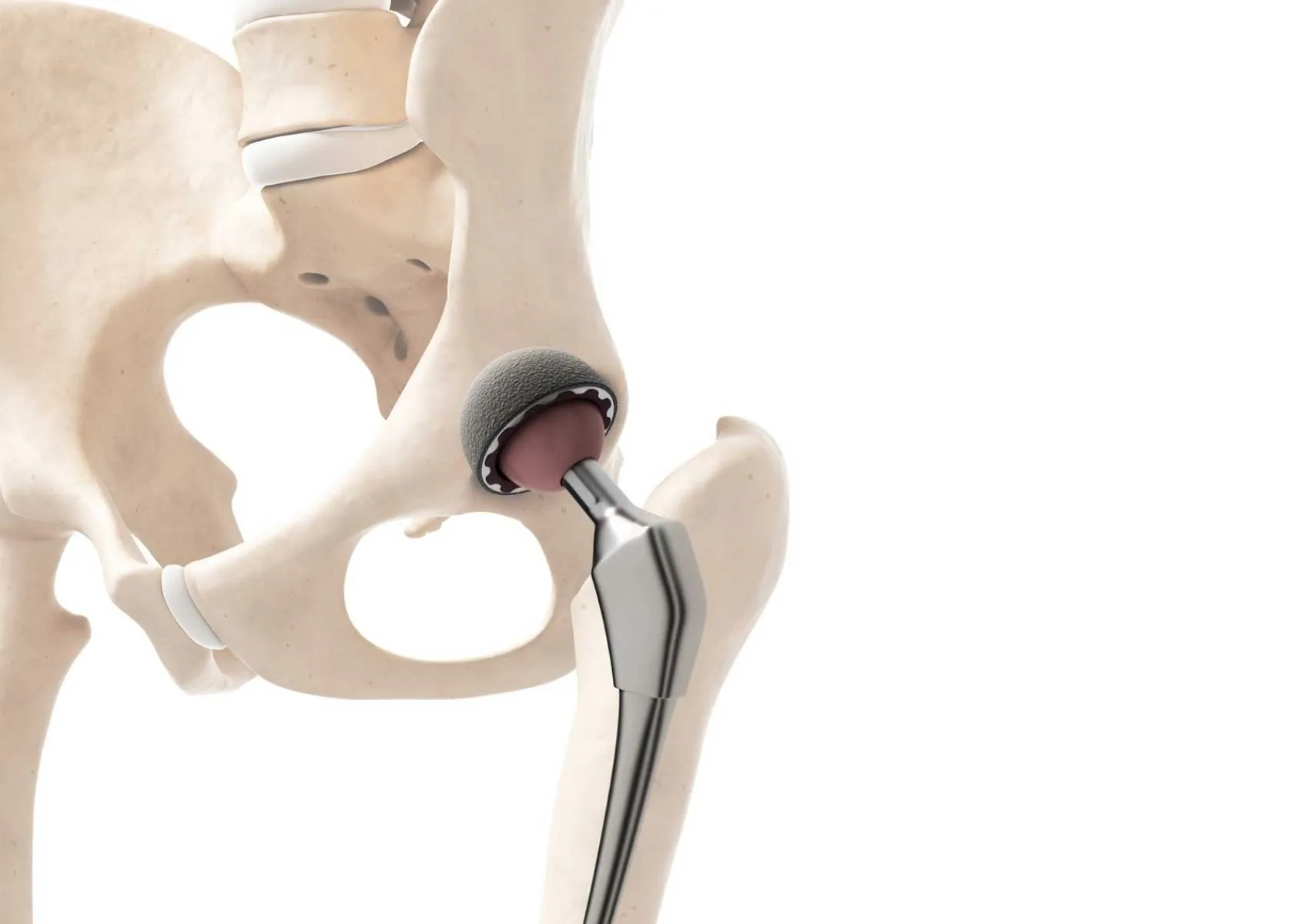 Who Needs a Hip Replacement?