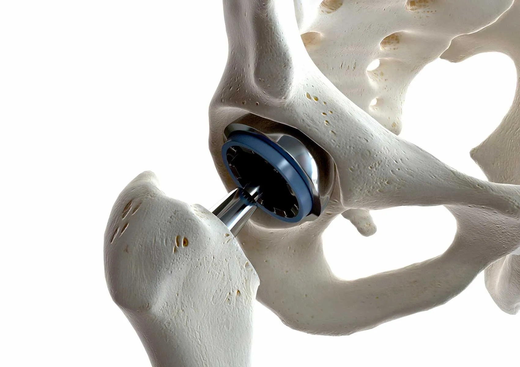 Kalça Protezinde Çıkık Riski ve Önlemler