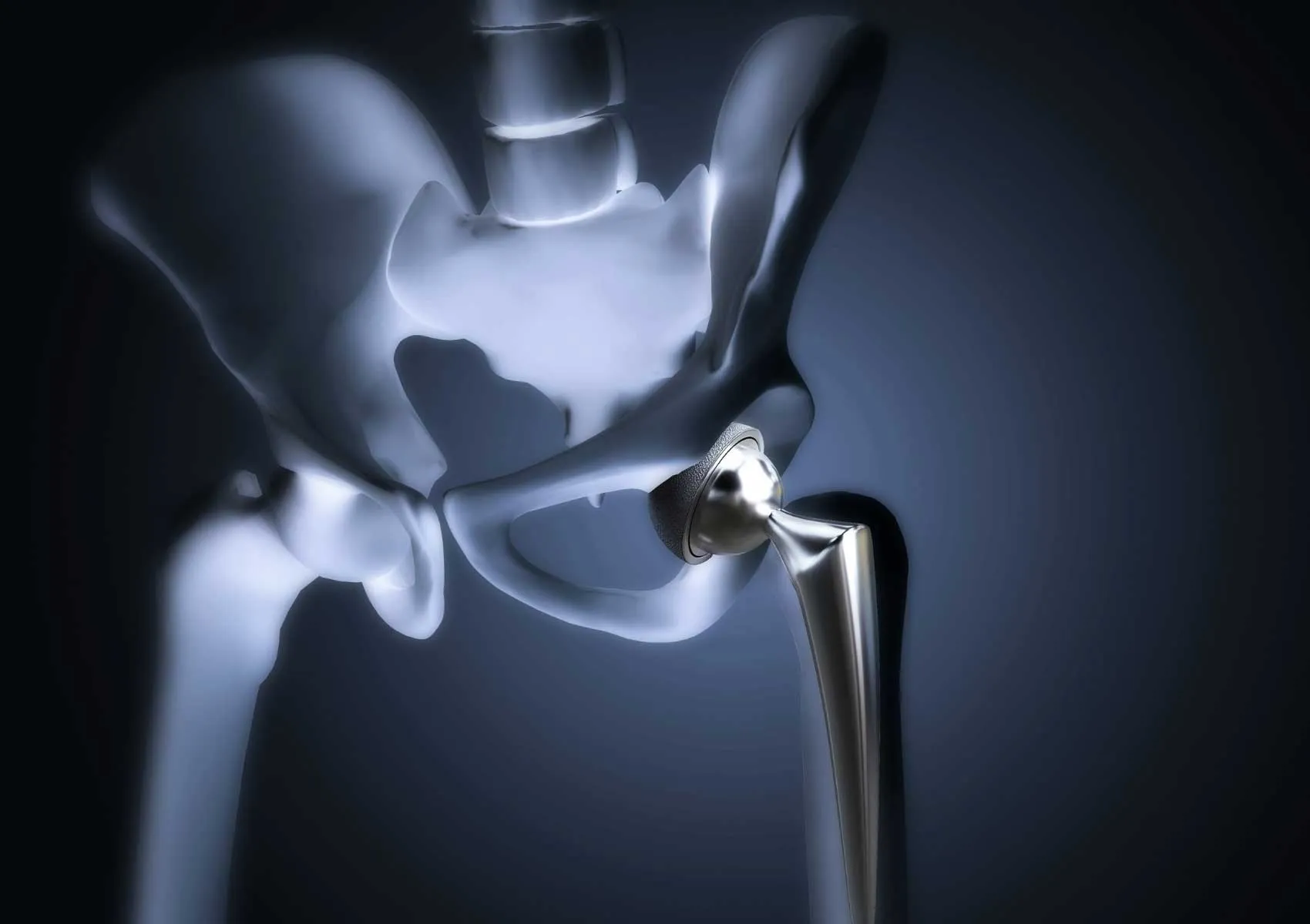 Robotic Surgery in Hip Replacement