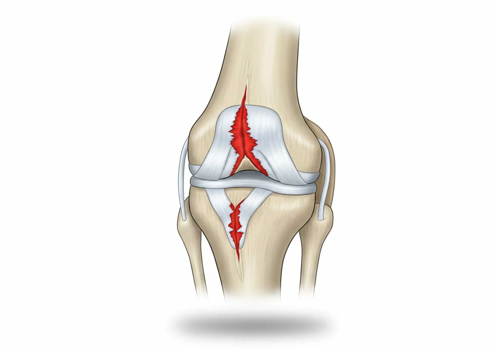 Menisküs Yırtığı Tedavisi: Kapsamlı Rehber ve İyileşme Süreci