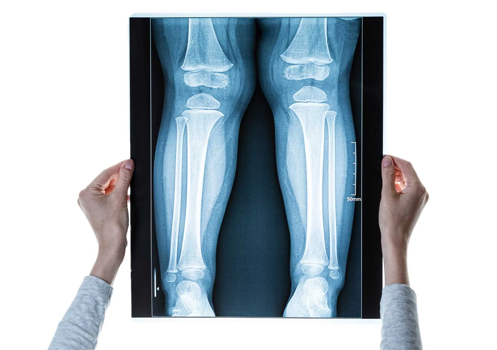 Osteotomi Sonrası Görüntüleme ve Kontroller