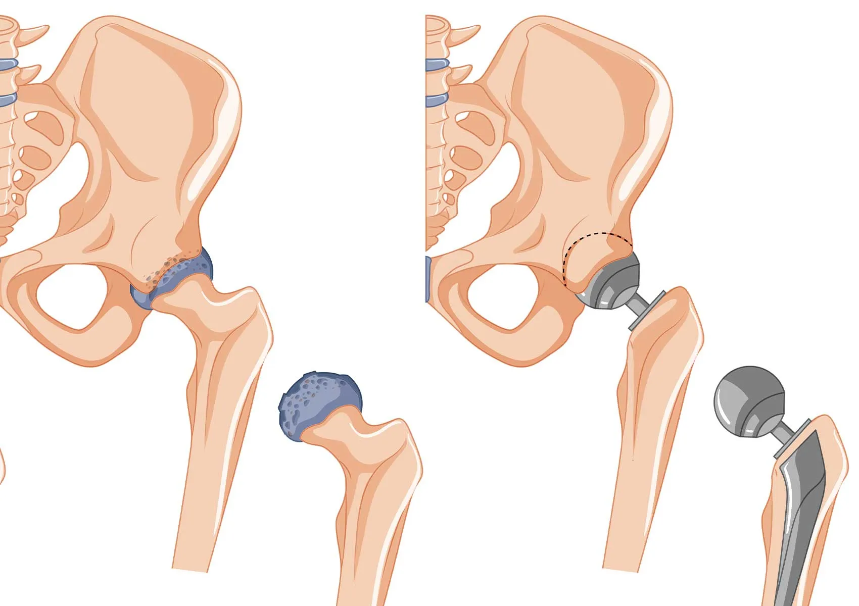 What You Should Know Before Joint Replacement Surgery