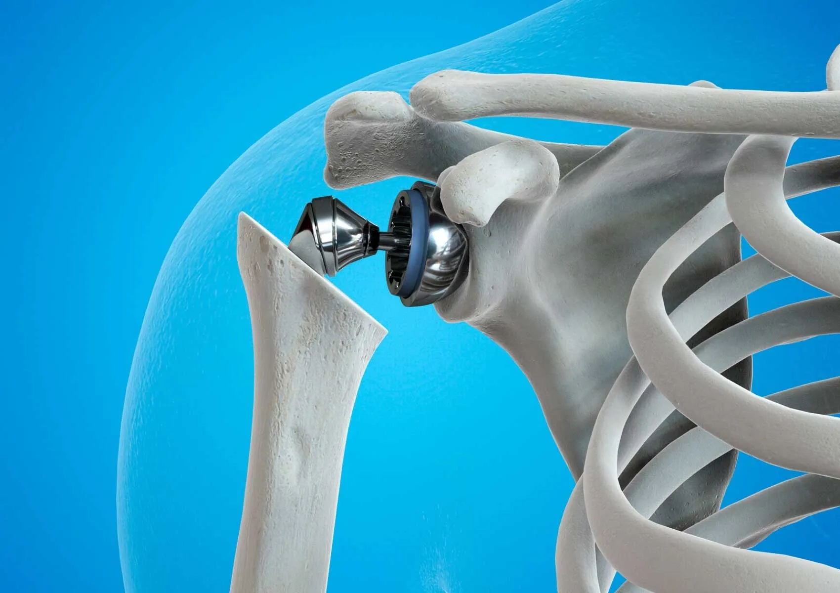 When Is Prosthetic Surgery Necessary?