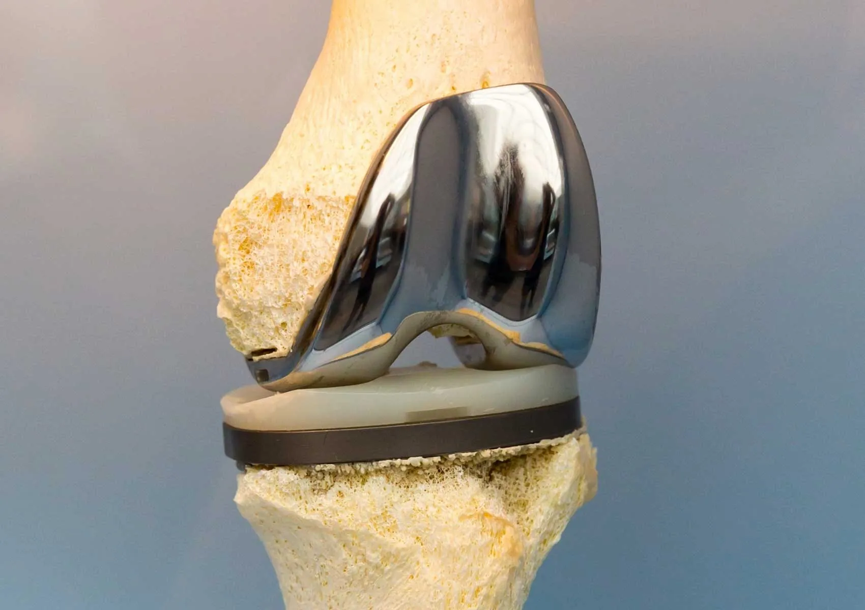 Materials Used in Prosthetic Surgery
