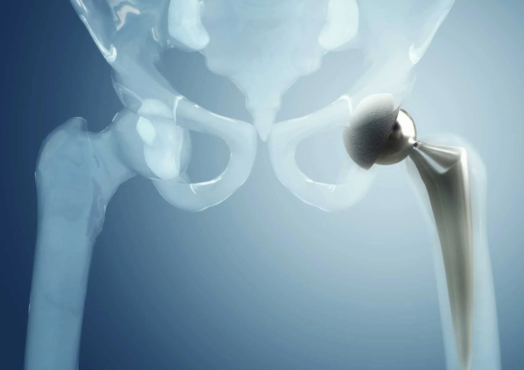 Protez Ömrü Nasıl Uzatılır?