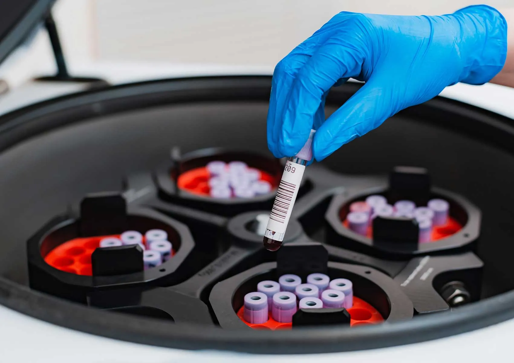 PRP Tedavisi Kaç Seans Uygulanmalıdır?