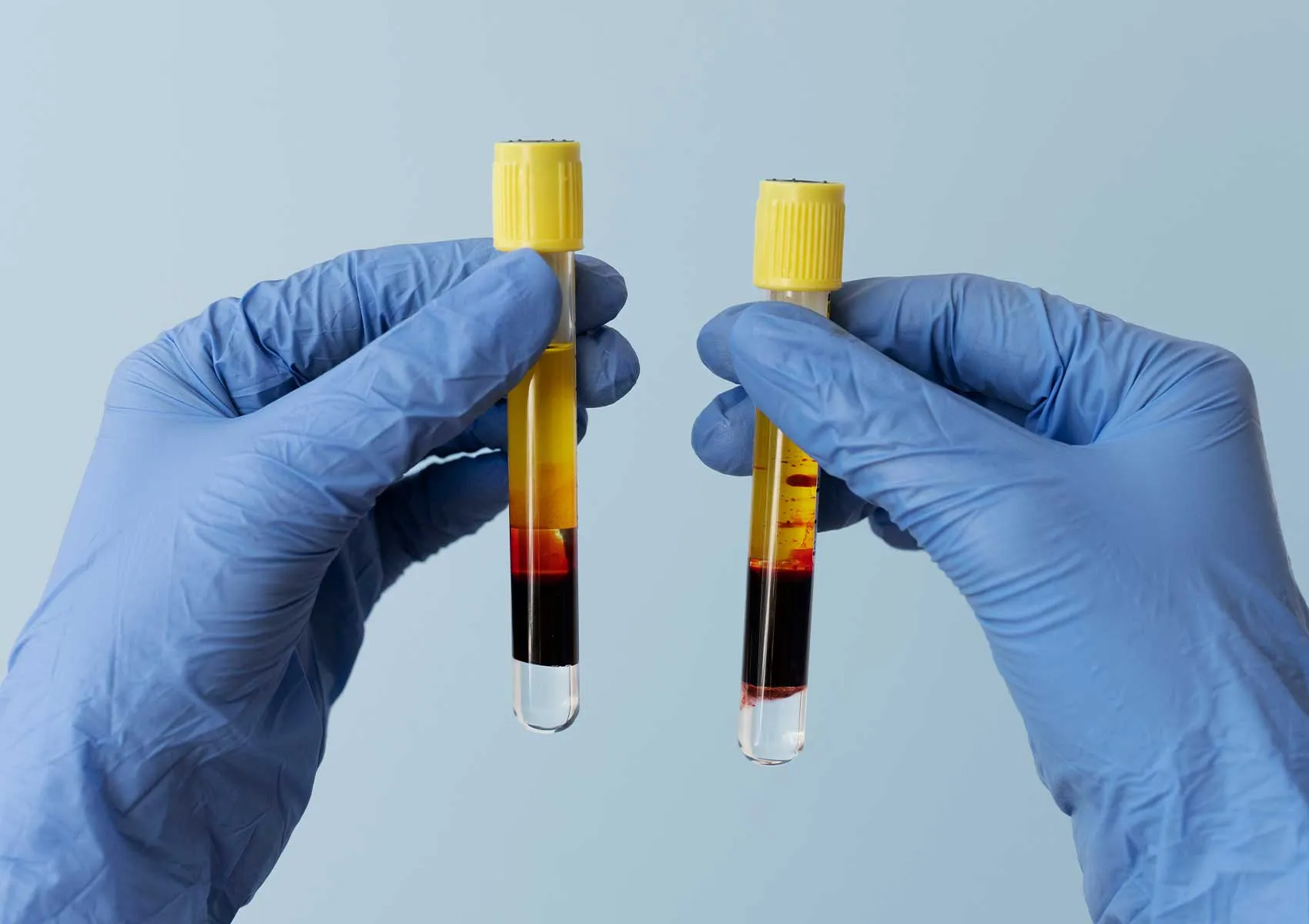 Are There Side Effects of PRP Therapy?