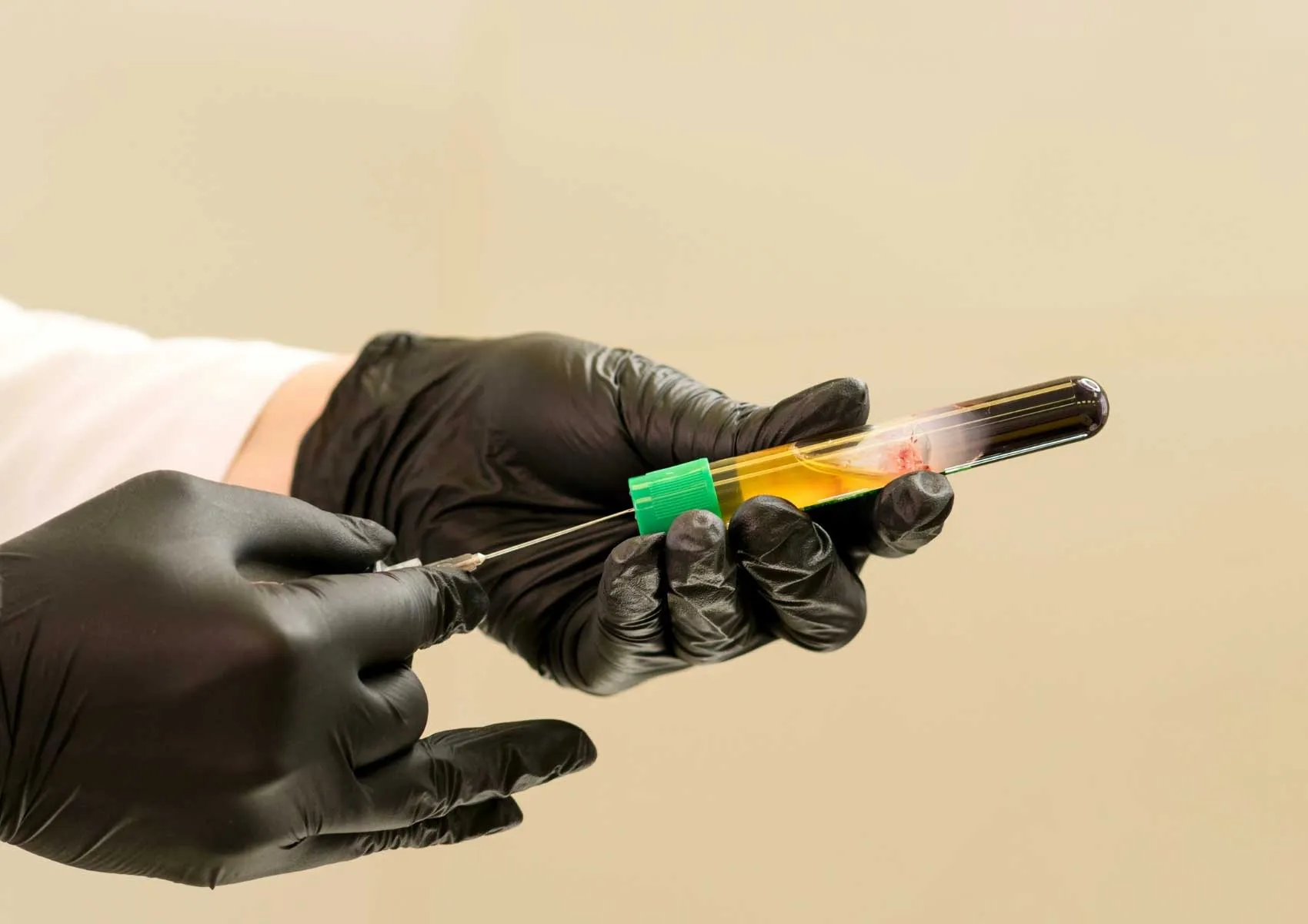 PRP Therapy in Sports Injuries: A Biological Boost for Faster Recovery