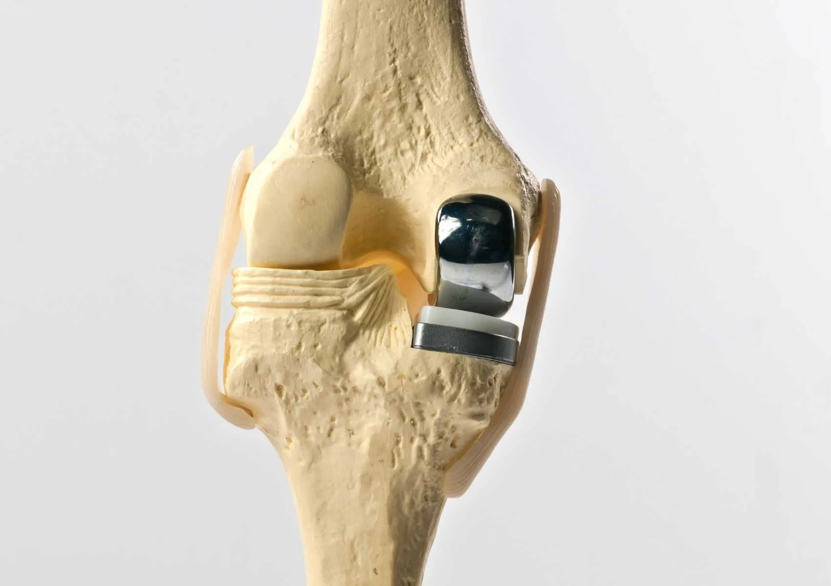 Yarım Diz Protezi Kimler İçin Uygun?